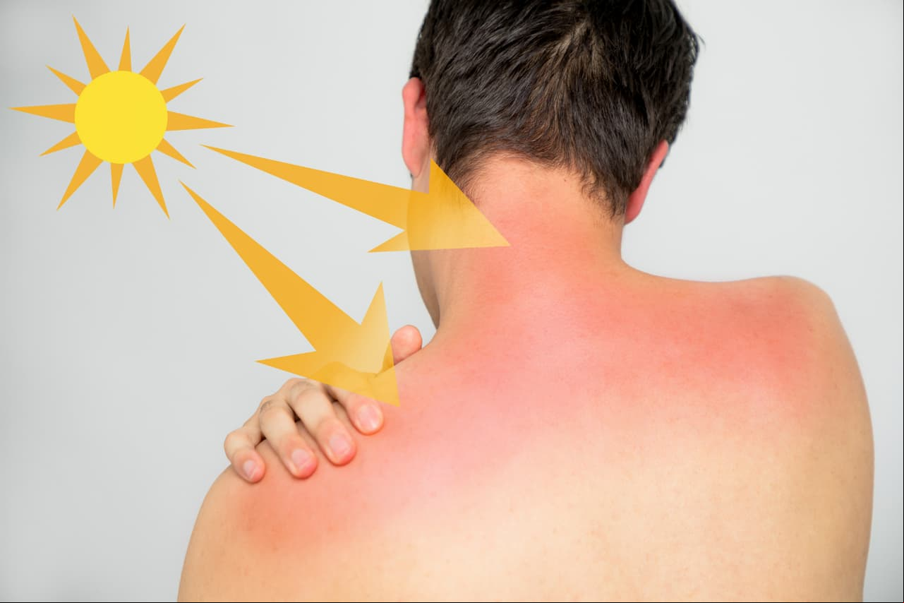Cinco señales que indican que podrías ser alérgico al sol