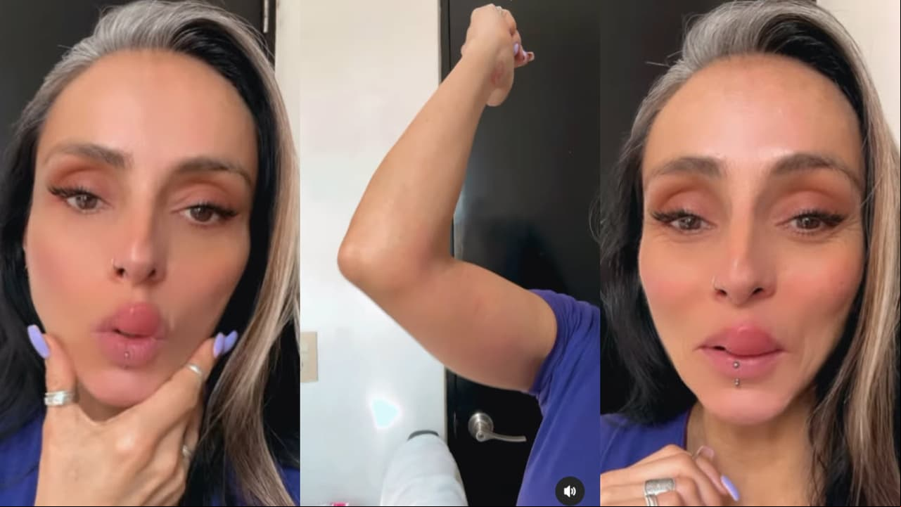 Ivonne Montero también mostró la picadura que sufrió en uno de sus brazos.