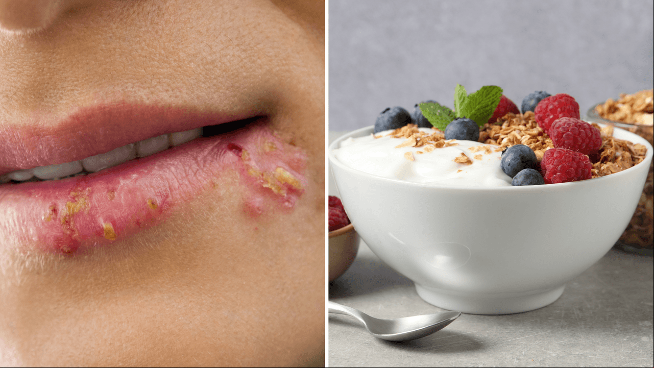 Las personas propensas a tener herpes deben comer estos 11 alimentos que bloquean el virus