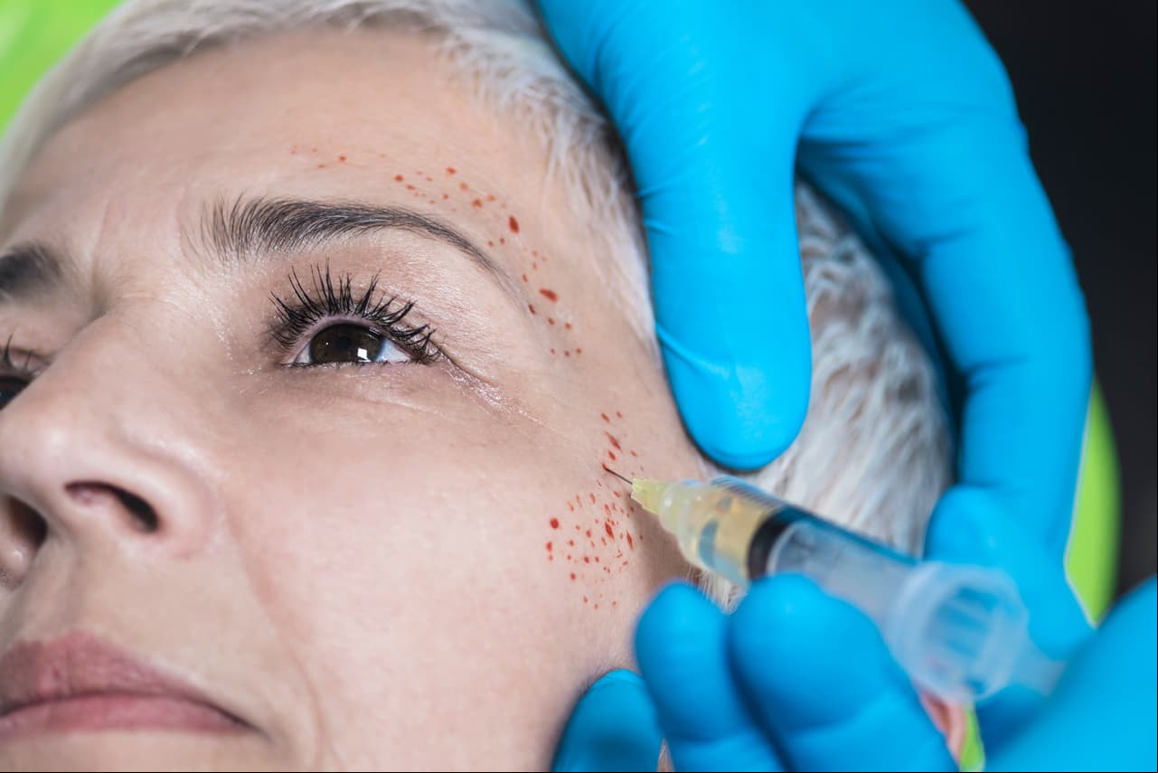 ¿Qué es el facial de vampiro, el tratamiento por el que dos mujeres se contagiaron de VIH?