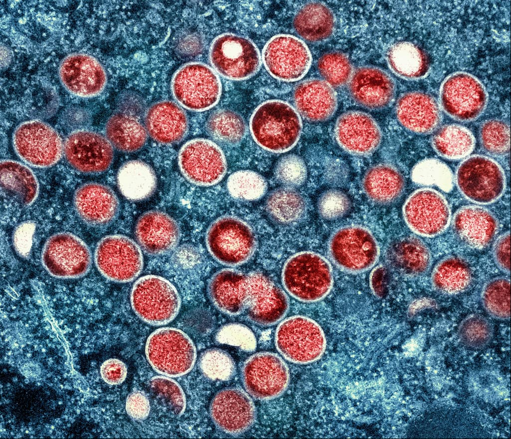 Reportan el primer caso de viruela del mono fuera de África: qué protección tienen los ya vacunados 