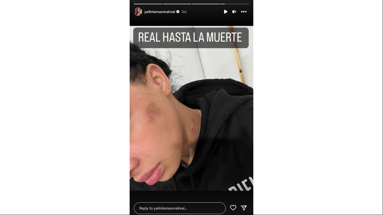 Yailin muestra los presuntos golpes de Anuel
