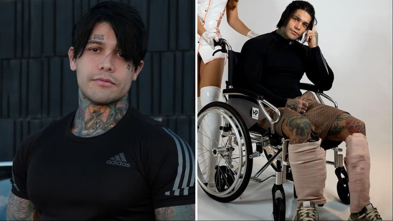 Influencer se somete a cirugía de alargamiento de piernas y vive traumática recuperación